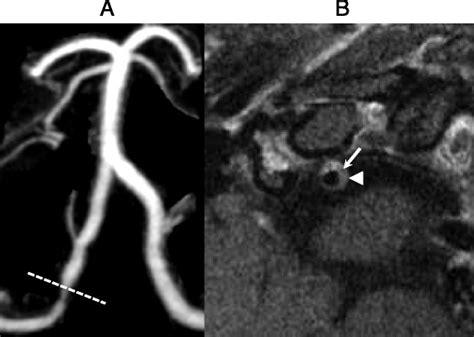 Intracranial Vessel Wall Imaging Current Applications And Clinical