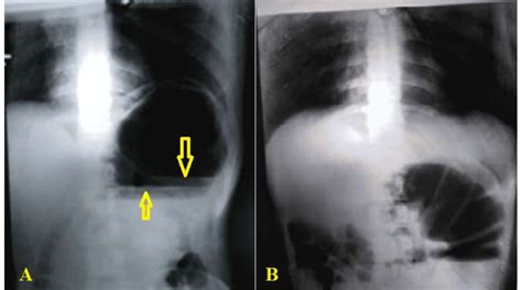 Plain Abdominal Radiography Showing Two Large Well Defined Air Fluid Download Scientific