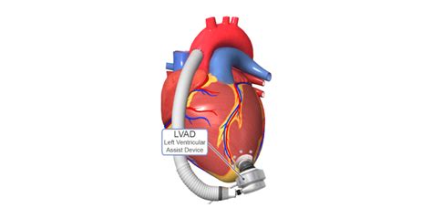 Lvad For Heart Failure