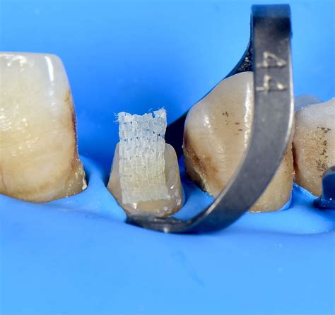 Using “Ribbond” to save destructive lateral incisor ! - MyZerodonto