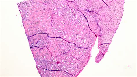 Pathology Outlines Bile Duct Adenoma