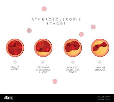 Atherosclerosis Stages Cholesterol Plaque Buildup Stock