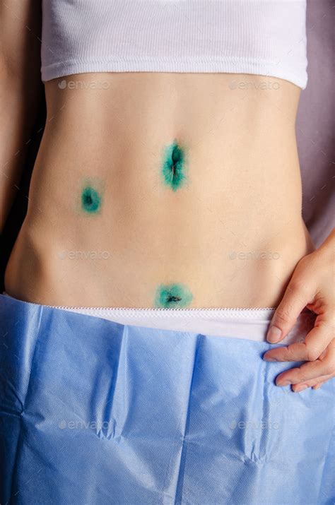 Middle Age Caucasian Female Shows Her Healing Scars After Laparoscopic Appendix Removal Surgery