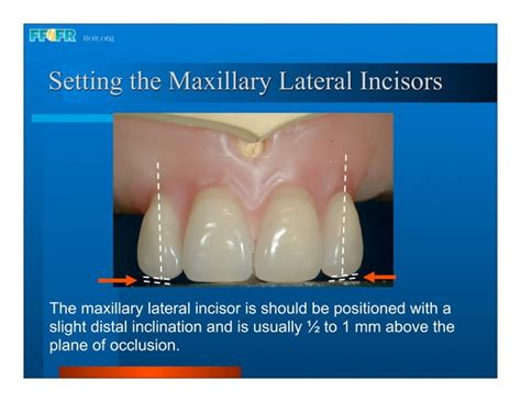 Complete Dentures 16occlusal Schemes Lingualized Occlusion Ppt