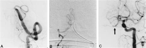 Case Proximal Basilar Thrombosis With Collateral Filling Of The