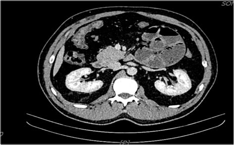 Axial Contrast Enhanced Abdominal Computed Tomography Ct Images Of