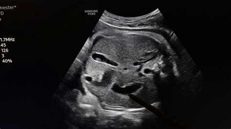 Fetal Bladder Ultrasound