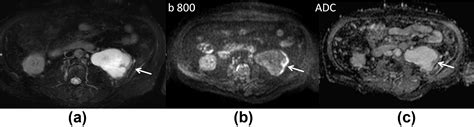 Diffusion Weighted Imaging In Urinary Tract Lesions Clinical Radiology