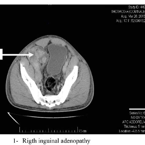 Right inguinal adenopathy with areas of necrosis. | Download Scientific Diagram