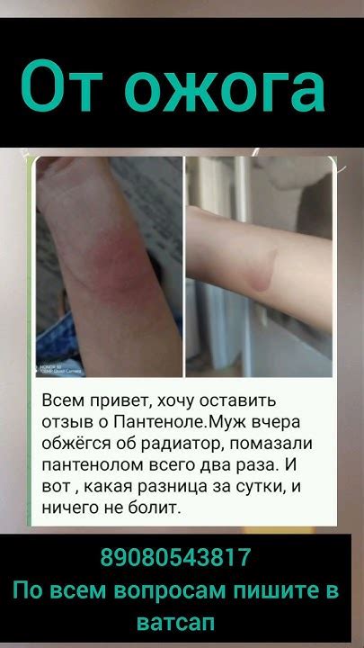 от ожога - YouTube