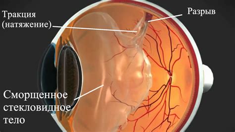 Как выглядит разрыв сетчатки глаза