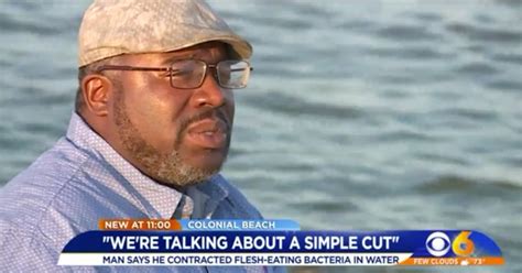 Maryland Man Contracted Flesh Eating Bacteria Through Simple Cut