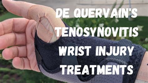 De Quervains Tenosynovitis Wrist Injury Treatments Youtube