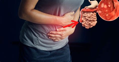 Colitis ulcerosa 7 síntomas que nadie debería pasar por alto además