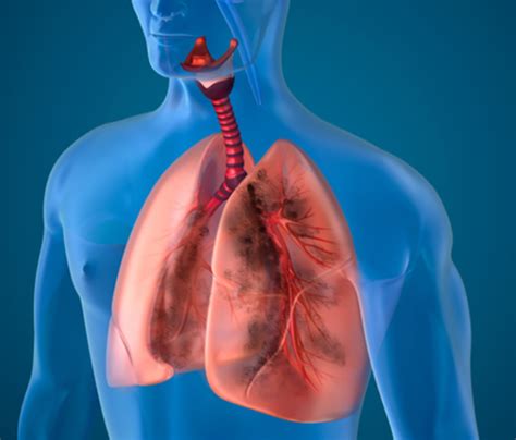 Interstitial Lung Disease Causes