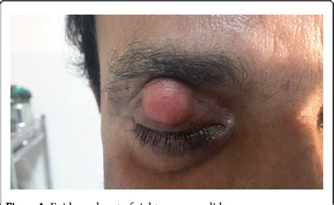 Figure 1 from Epidermal Cyst of Upper Eyelid: A Case Report with ...