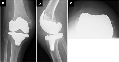 Total Knee Arthroplasty Without Reduction Of The Patella For Genu