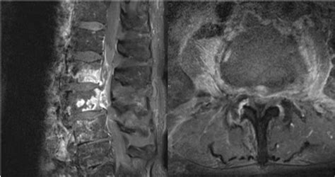 Postcontrast Sagittal A And Axial B Magnetic Resonance T