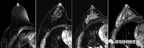 基于乳腺磁共振背景实质强化程度与乳腺癌不同分子亚型及临床因素 知乎