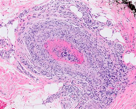 Vasculitis Histology