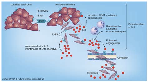 Potential Role Of The IL 8IL 8 Receptor Axis Along Tumor Progression