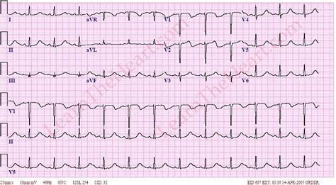 Hypocalcemia Ekg