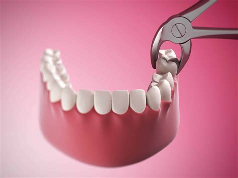 Woodland Hills Dentist Discusses The Process Of Extracting A Tooth