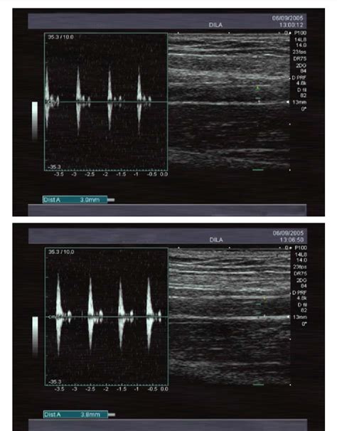 Figure From Reliability Of Brachial Artery Flow Mediated Dilatation