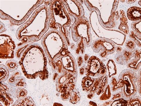 Immunohistochemical Features The Adenocarcinoma Component Is Strongly