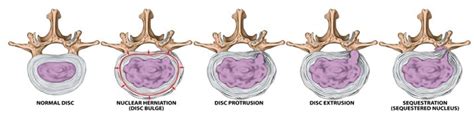 Herniated Disc Symptoms Treatment Spine Orthopedic Center