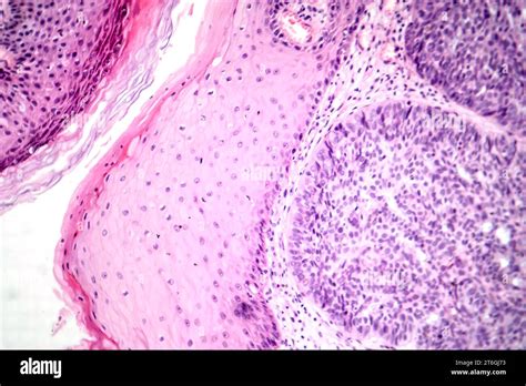 Fotomicrograf A Del Carcinoma Basocelular Que Muestra C Lulas Basales