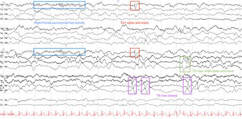 Epileptiform Activity On EEG