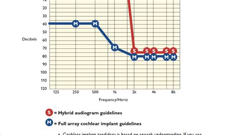 Cochlear Implant and Hybrid Implant Candidacy - BroadcastMed