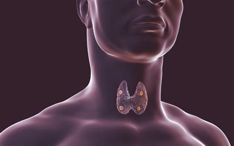 Thyroid Andaparathyroid Glands Hyperparathyroidism Surgery Dr