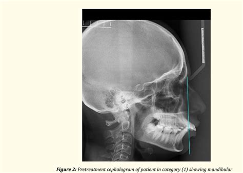 Skeletal Class Ii Malocclusion