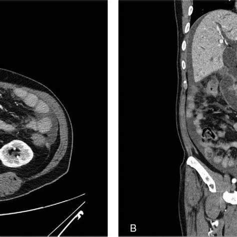 Percutaneous Transhepatic Biliary Drainage For The Treatment Of