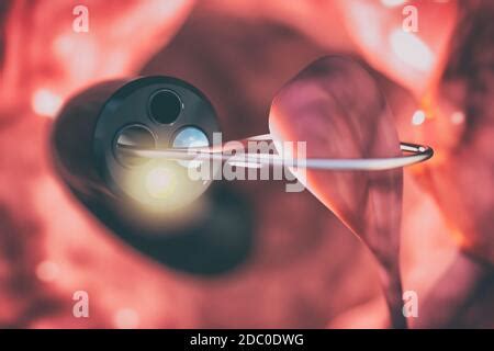 Extracción de pólipos de colon endoscopia Fotografía de stock Alamy