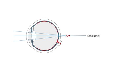 Farsightedness - Correction & Treatment at Test Winner EuroEyes