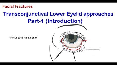 Transconjunctival Lower Eyelid Approaches Part I Oral Maxillofacial