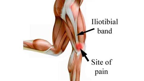 Iliotibial Tract IT Band Anatomy Origin Insertion 53 OFF