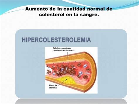 Hipercolesterolemia