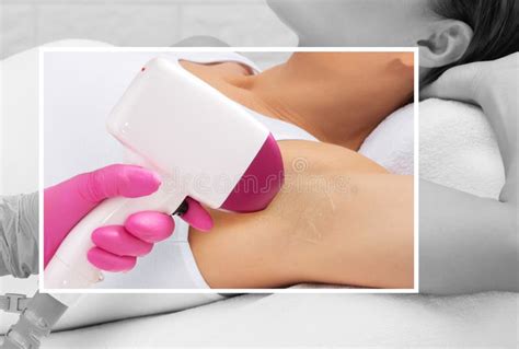 Elos Epilation Hair Removal Procedure On A Womans Body Beautician