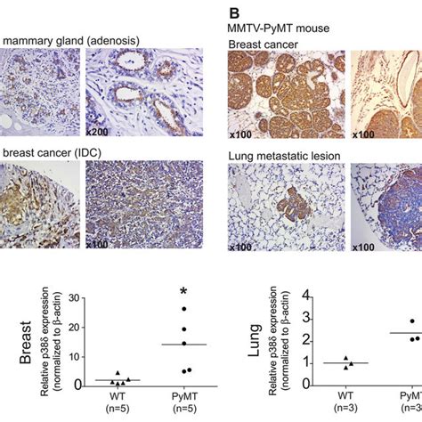 P Is Highly Expressed In Human And Mmtv Pymt Murine Breast Tumors A