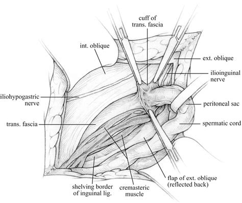 Figure 2 From The Shouldice Repair For Groin Hernias Semantic Scholar