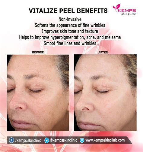 What Is Vitalize Peel Know About Its Benefits And Procedures Kemps