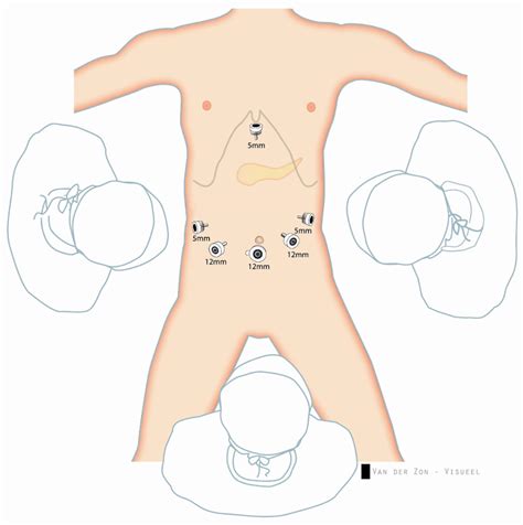 List 100 Wallpaper Pictures Of Laparoscopic Surgery Incisions Latest