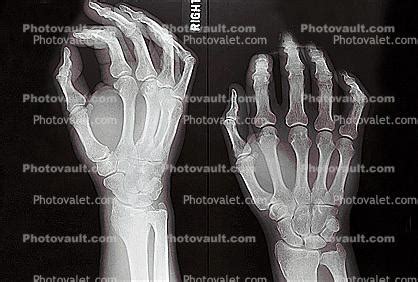 hand, fingers, knuckles, X-Ray, Anatomy, Skeletons, Photo