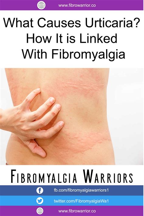 What Causes Urticaria How It Is Linked With Fibromyalgia Chronic