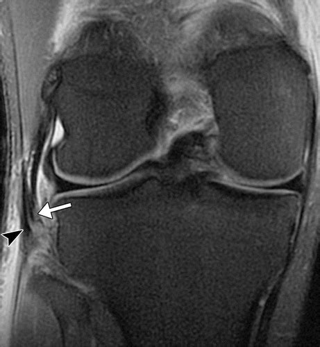 Popliteofibular Ligament Mri