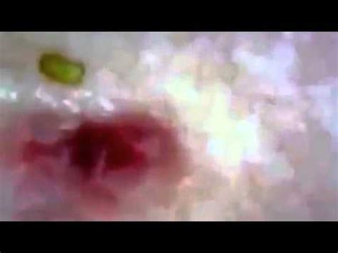 Zit Popping Extreme! Blackheads and Whiteheads - YouTube